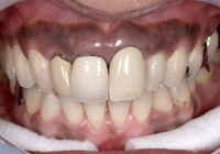 歯ぐきのホワイトニング「ガムブリーチ」1