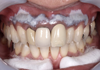歯ぐきのホワイトニング「ガムブリーチ」2