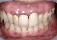 歯ぐきのホワイトニング「ガムブリーチ」3