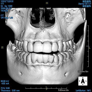 歯科用CT2