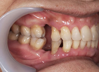 ノンクラスプデンチャーと保険の入れ歯を使用した例1
