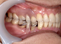 ノンクラスプデンチャーと保険の入れ歯を使用した例3