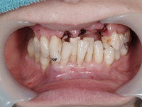 前歯を抜歯して入れ歯を入れた例2