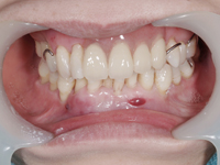 前歯を抜歯して入れ歯を入れた例3