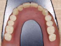 合わない入れ歯をマグネットデンチャーに替えた例2After